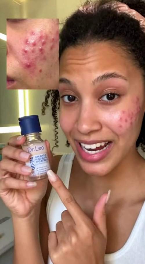 夜用祛痘实录:隔日消肿变平